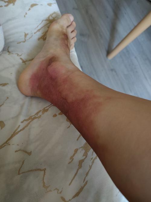 江都一初中生在家做实验，导致大腿烧伤